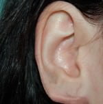 Earlobe Repair