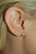 Earlobe Repair