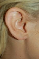 Earlobe Repair