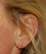 Earlobe Repair