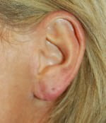 Earlobe Repair