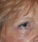 Eyelid Surgery