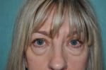 Eyelid Surgery
