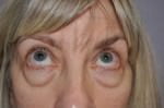 Eyelid Surgery