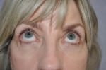 Eyelid Surgery