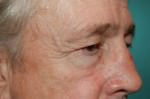 Eyelid Surgery