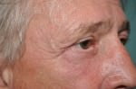 Eyelid Surgery