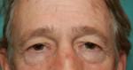 Eyelid Surgery
