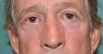 Eyelid Surgery