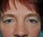 Eyelid Surgery