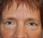 Eyelid Surgery