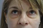Eyelid Surgery