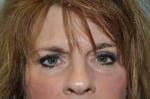 Eyelid Surgery