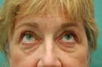 Eyelid Surgery