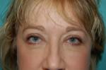 Eyelid Surgery