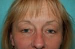 Eyelid Surgery