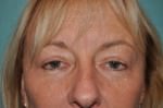 Eyelid Surgery