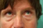 Eyelid Surgery