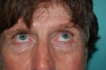 Eyelid Surgery