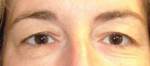 Eyelid Surgery
