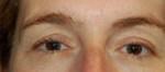 Eyelid Surgery