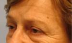 Eyelid Surgery