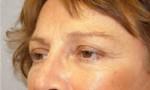Eyelid Surgery