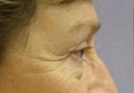 Eyelid Surgery
