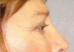 Eyelid Surgery