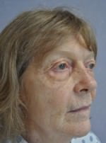 Face Lift