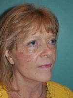 Face Lift