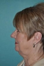 Face Lift