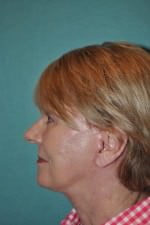 Face Lift