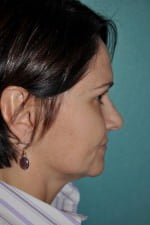 Face Lift