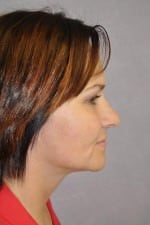 Face Lift