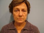 Facelift Surgery Results Cincinnati