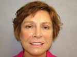 Facelift Surgery Results Cincinnati