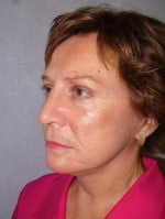 Face Lift