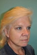 Face Lift