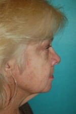 Face Lift