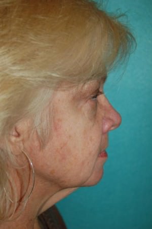 Face Lift Case 2457 Before Photo Face Lift