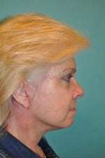 Face Lift