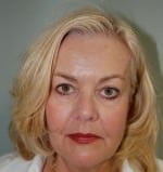 Face Lift