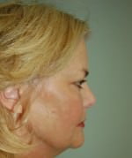 Face Lift
