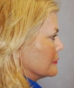 Face Lift