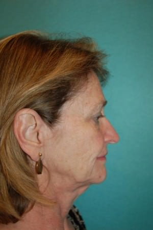 Face Lift Case 2471 Before Photo Face Lift