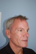 Face Lift