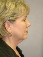 Face Lift