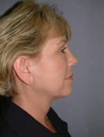 Face Lift