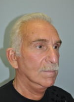 Face Lift